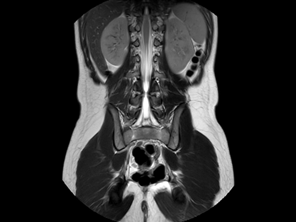 Coronal T2w TSE MultiVane XD