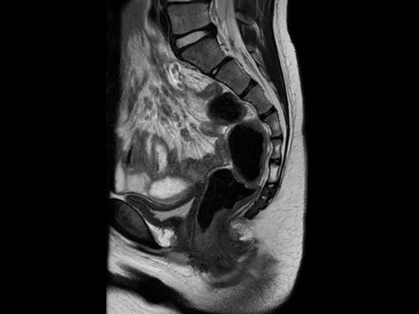 Sagittal T2w TSE