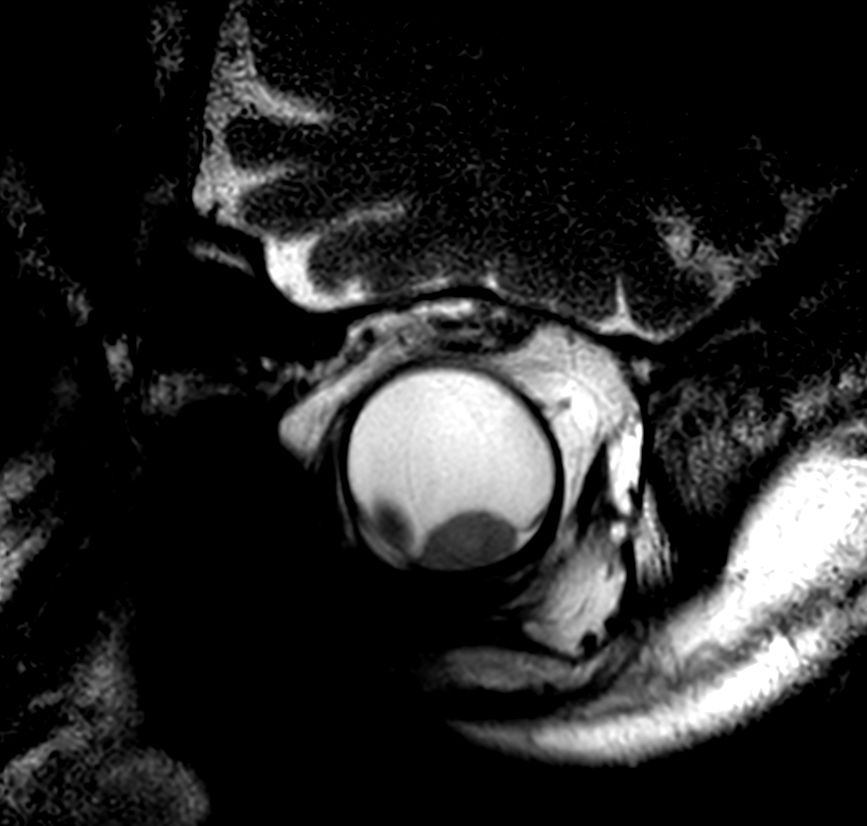 2D T2w TSE - Oblique coronal