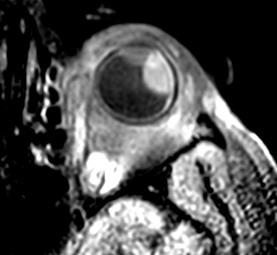 3D T1w TSE FatSat - Axial