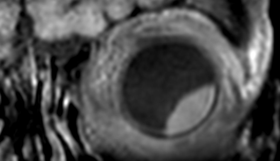 3D T1w TSE FatSat - Coronal reformat