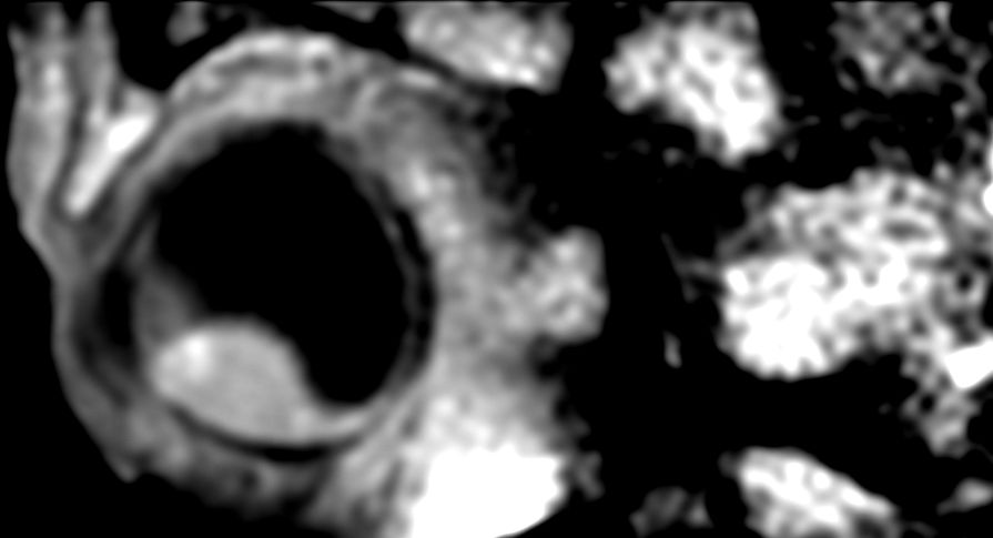3D T1w TSE FatSat - Sagital reformat