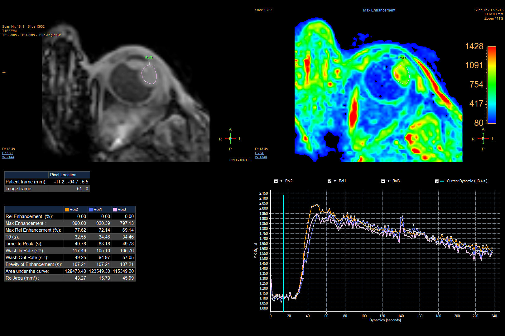 Perfusion - 125 dynamics (IntelliSpace Portal)