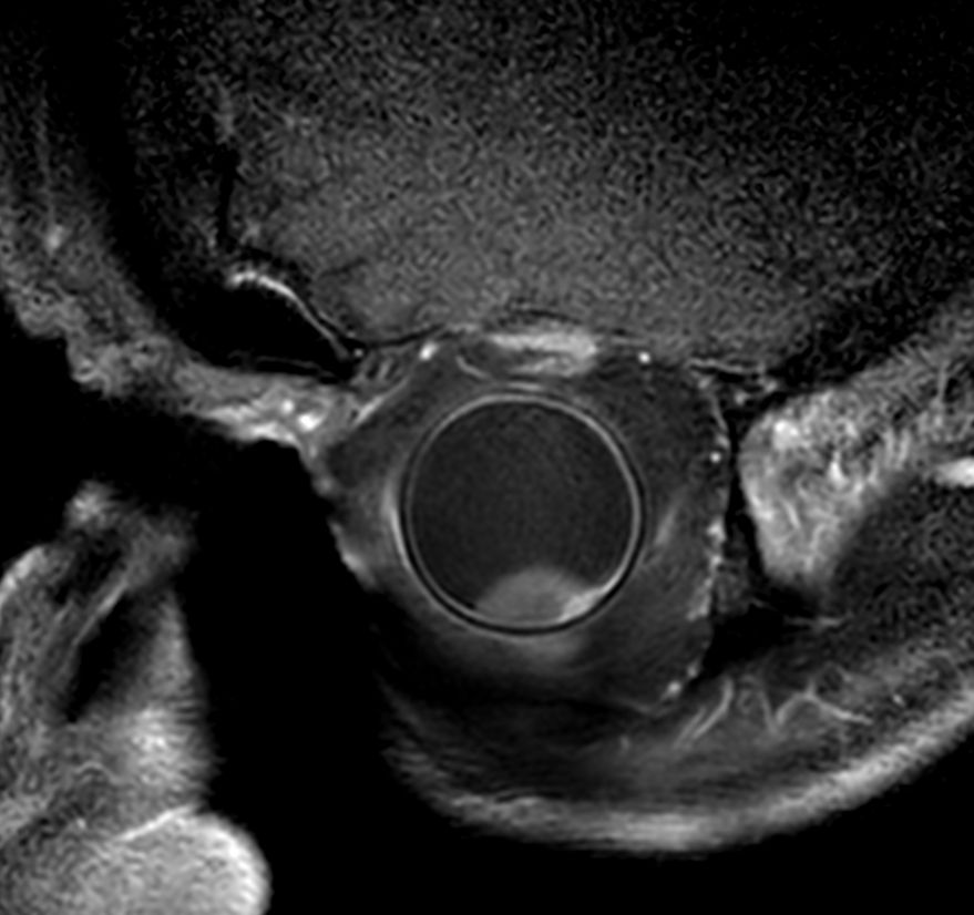 2D T1w TSE FatSat post gado - Oblique coronal