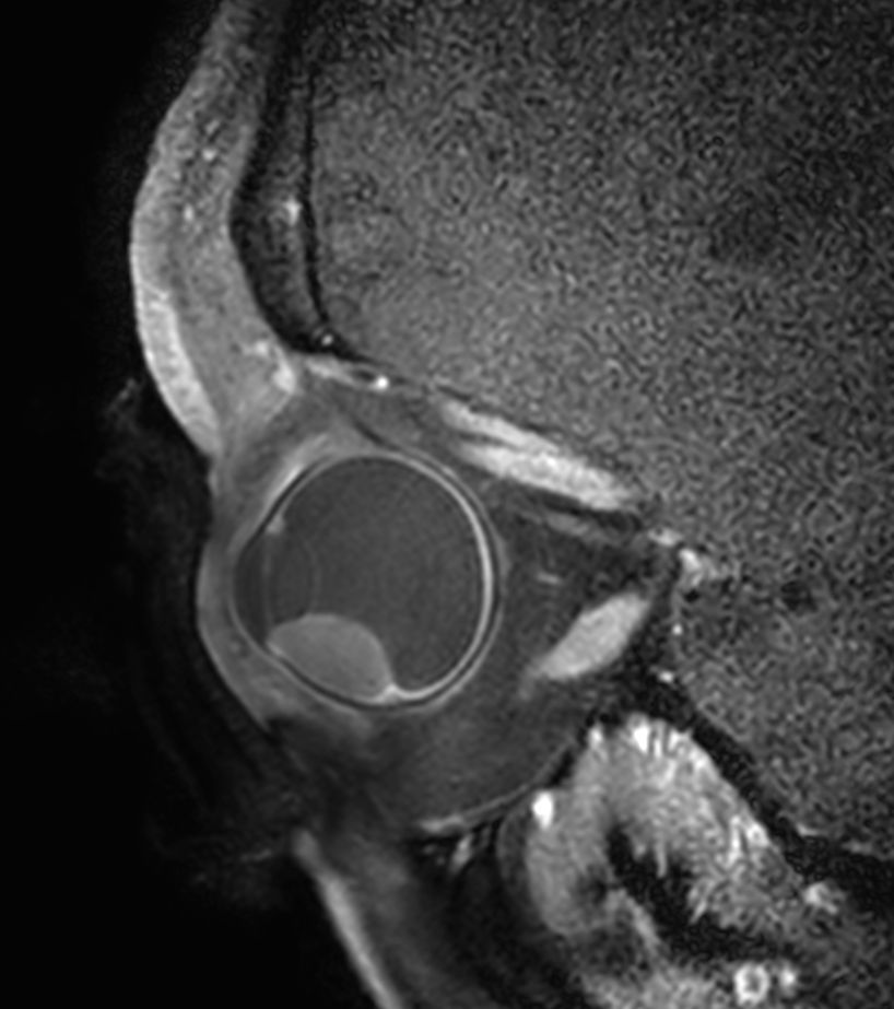 2D T1w TSE FatSat post gado - Oblique sagital