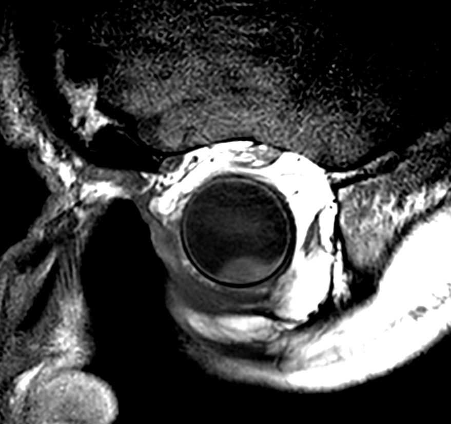 2D T1w TSE - Oblique coronal