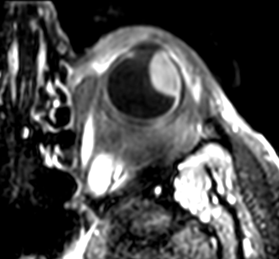 3D T1w TSE FatSat post gado - Axial