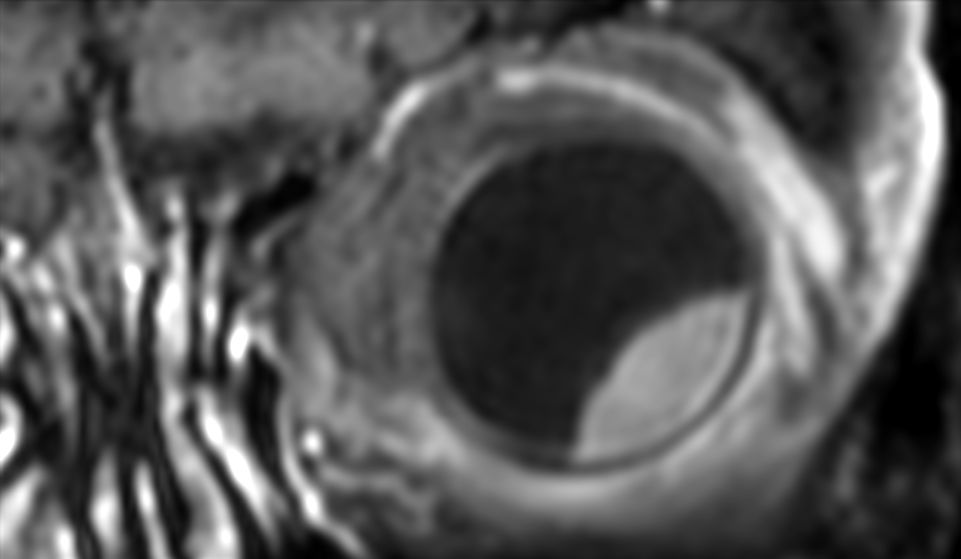 3D T1w TSE FatSat post gado - Coronal reformat