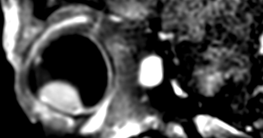 3D T1w TSE FatSat post gado - Sagital reformat