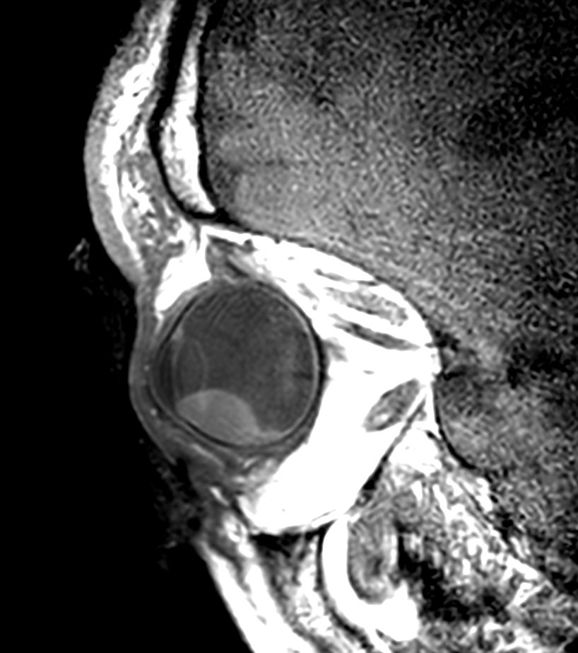 2D T1w TSE - Oblique sagittal