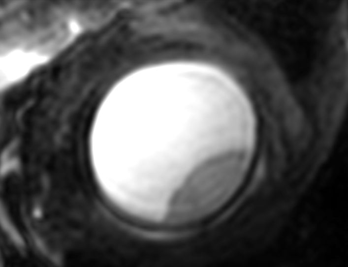 3D T2w TSE - Coronal reformat