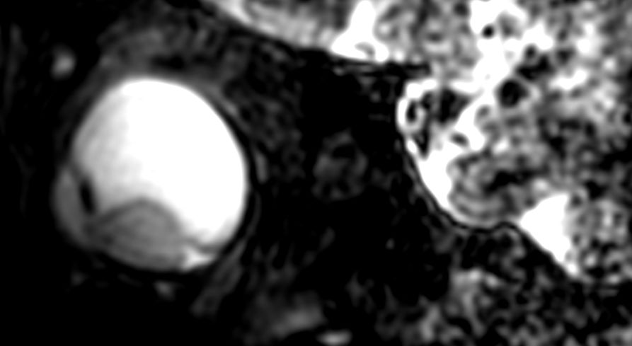 3D T2w TSE - Sagital reformat