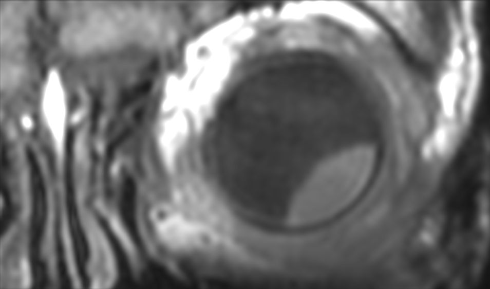 3D T1w TSE - Coronal reformat