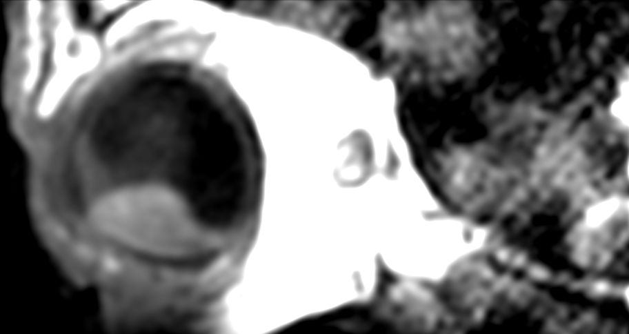 3D T1w TSE - Sagital reformat