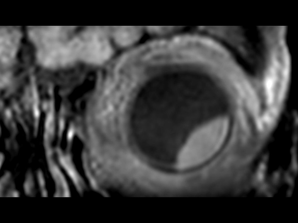 3D T1w TSE FatSat - Coronal reformat