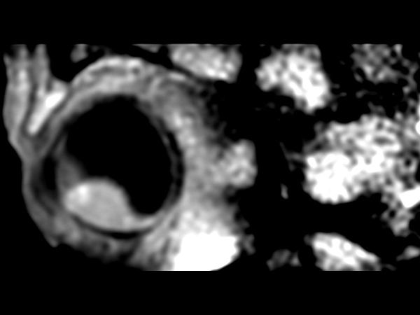 3D T1w TSE FatSat - Sagital reformat