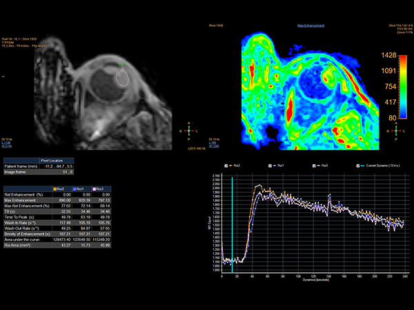 Perfusion - 125 dynamics (IntelliSpace Portal)