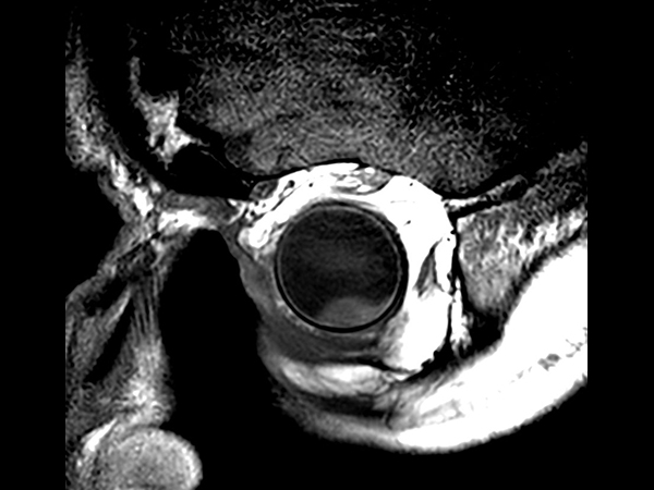 2D T1w TSE - Oblique coronal