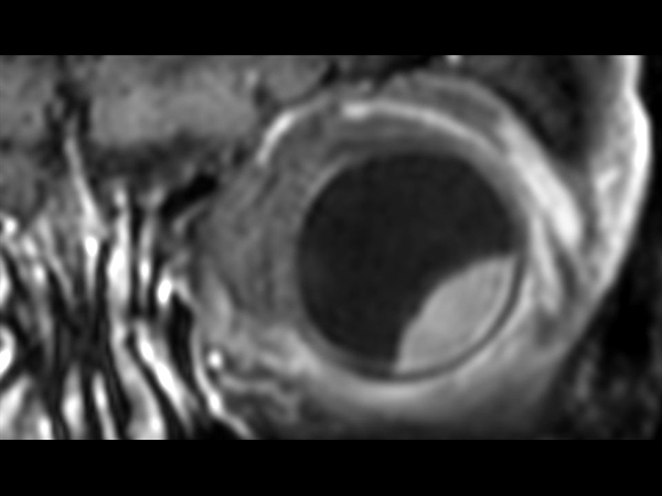 3D T1w TSE FatSat post gado - Coronal reformat