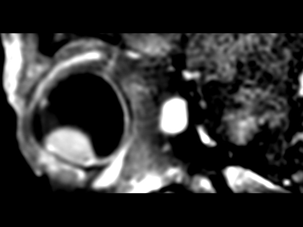 3D T1w TSE FatSat post gado - Sagital reformat