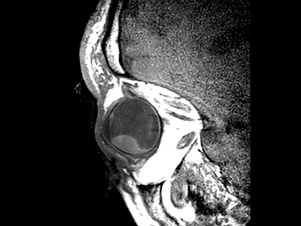 2D T1w TSE - Oblique sagittal