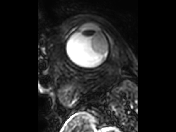 3D T2w TSE - Axial