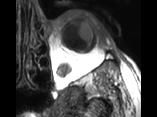 3D T1w TSE - Axial