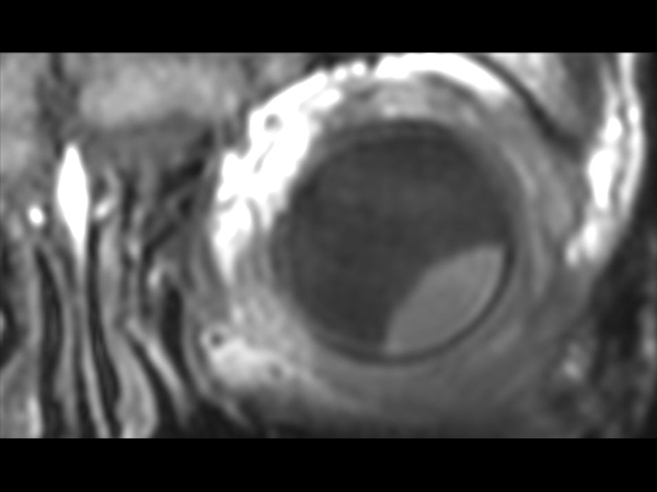 3D T1w TSE - Coronal reformat