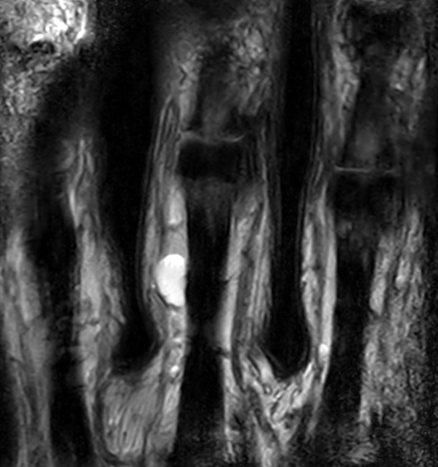 Coronal T2w TSE <b>Compressed SENSE</b>