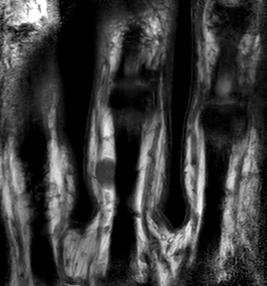 Coronal T1w TSE<b>Compressed SENSE</b>