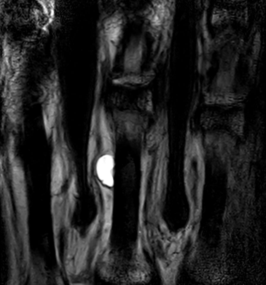 Coronal 3D T2w TSE <b>Compressed SENSE</b>