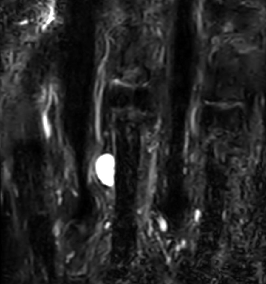 Coronal STIR TSE<b>Compressed SENSE</b>