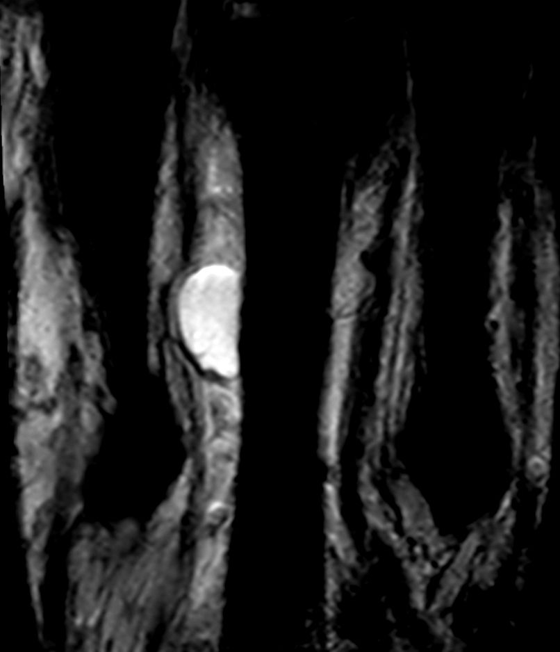 Coronal T2w TSE - Small FOV<b>Compressed SENSE</b>