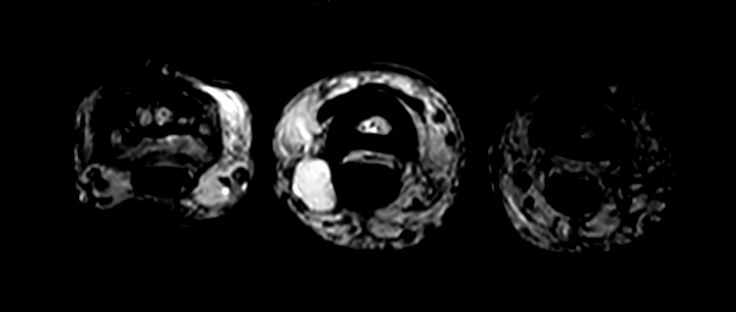 Axial T2w TSE<b>Compressed SENSE</b>