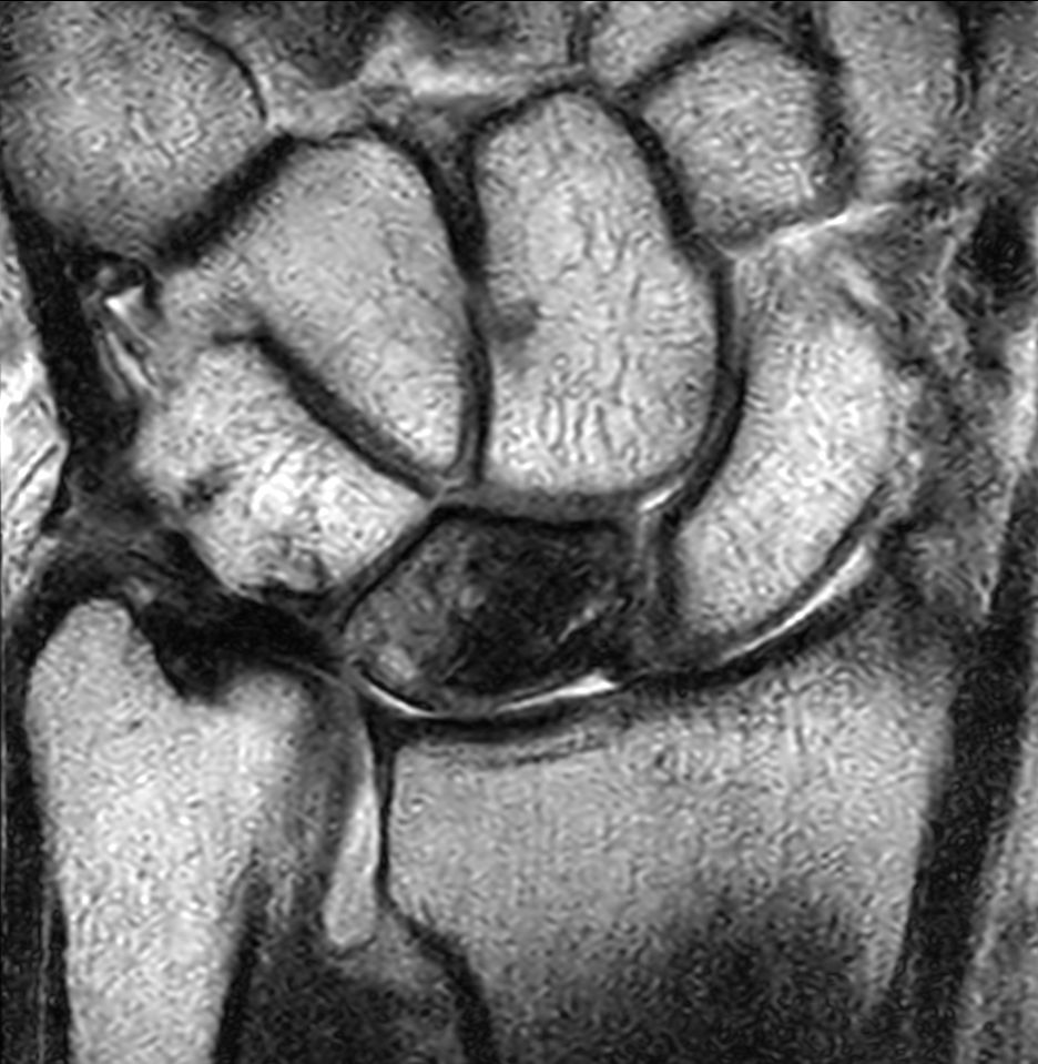 Coronal T2w TSE<b>Compressed SENSE</b>