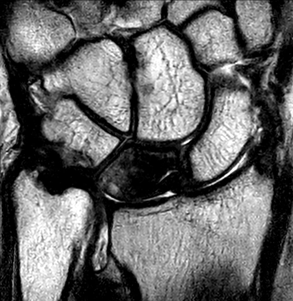 Coronal 3D T2w TSE<b>Compressed SENSE</b>