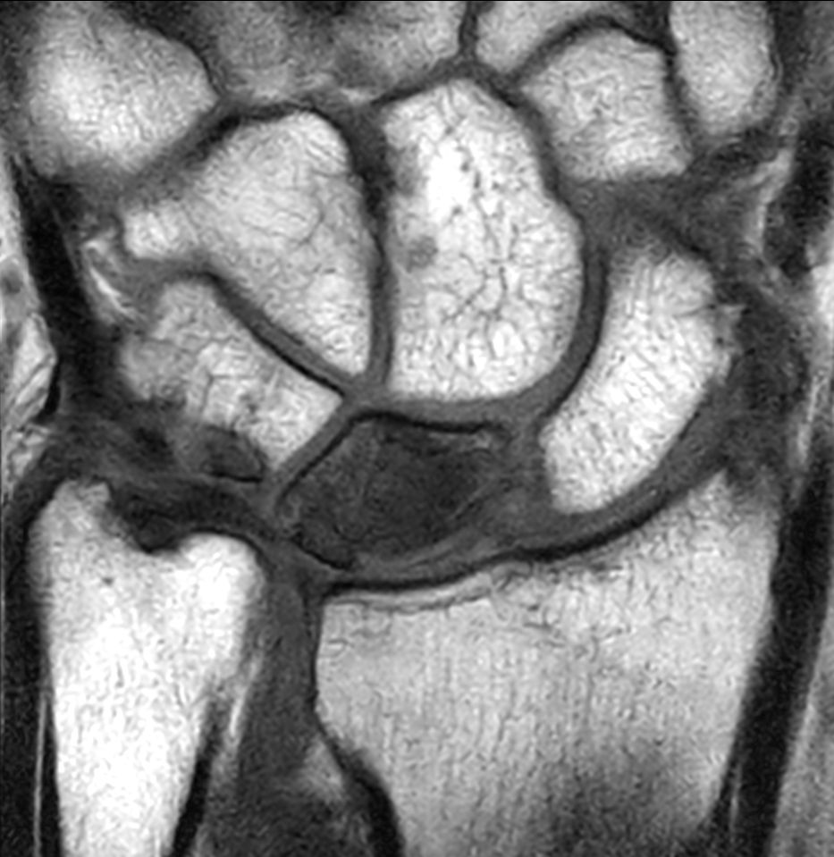 Coronal 3D T1w TSE<b>Compressed SENSE</b>