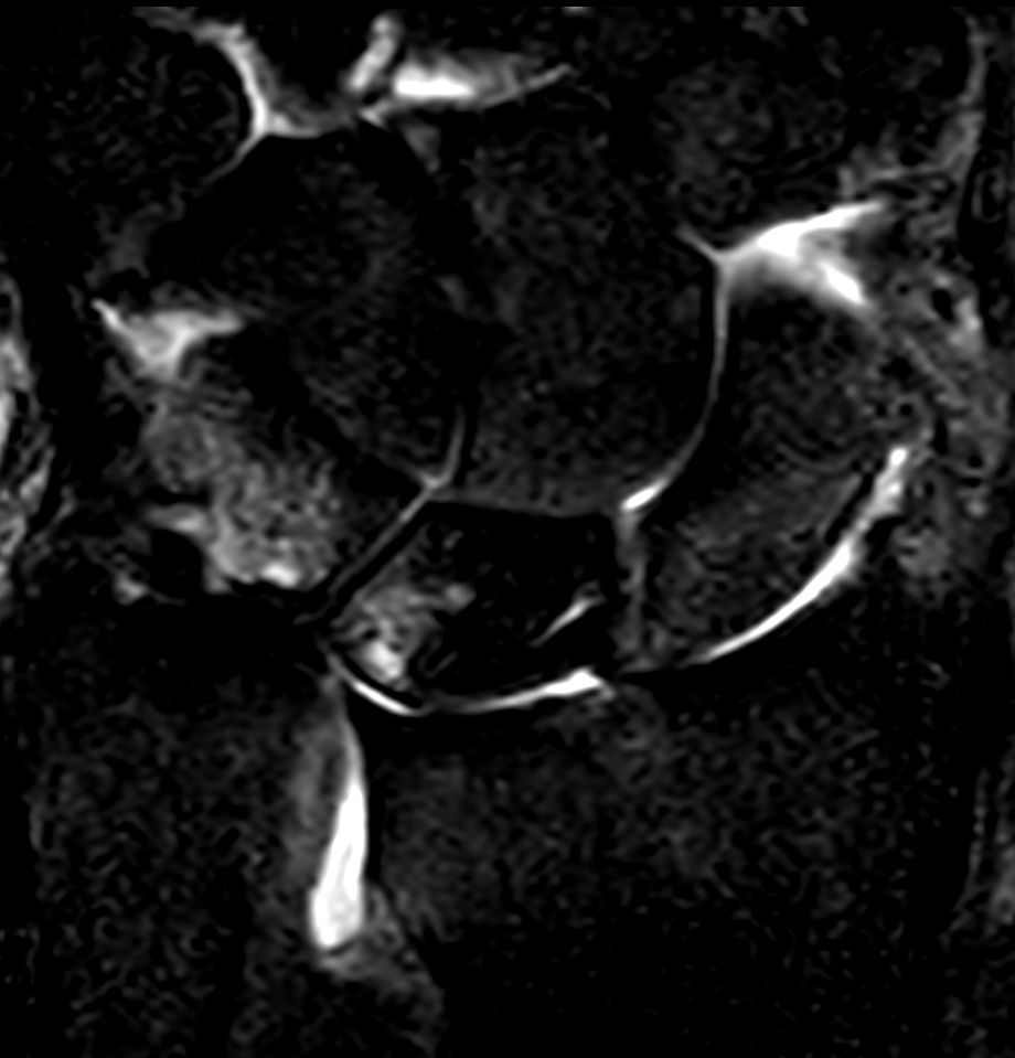 Coronal STIR TSE<b>Compressed SENSE</b>