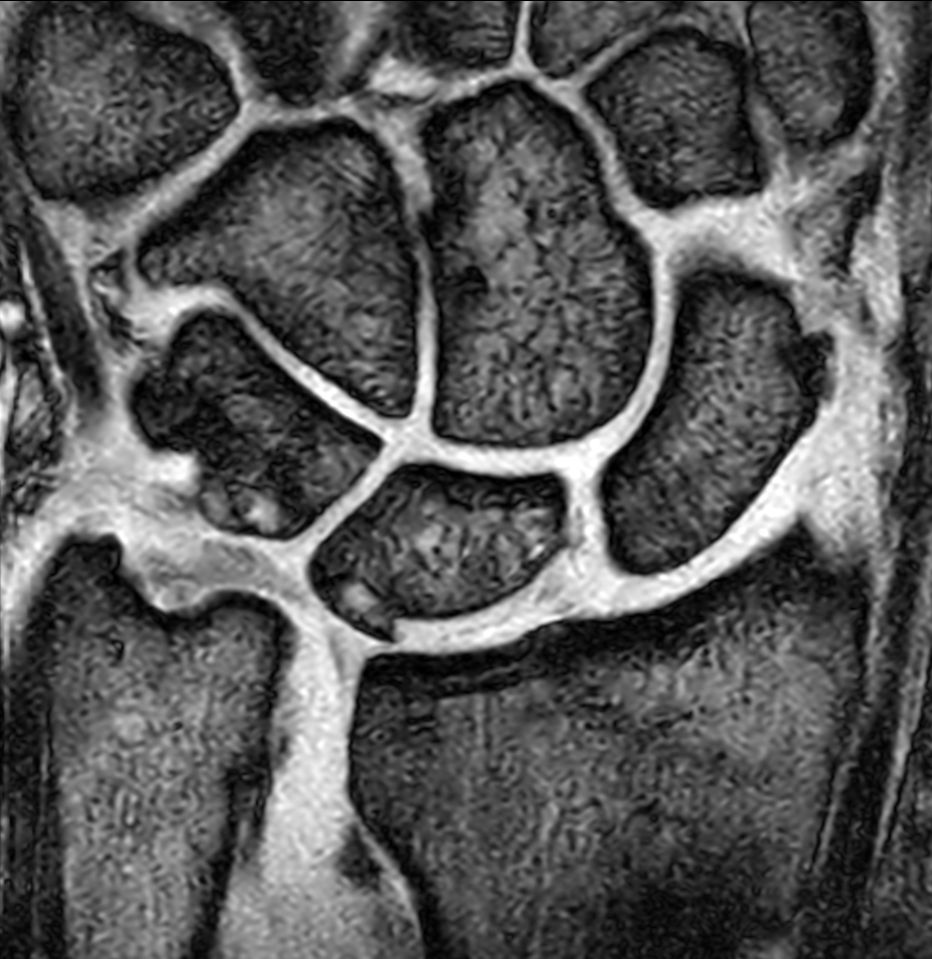 Coronal T2w FFE<b>Compressed SENSE</b>