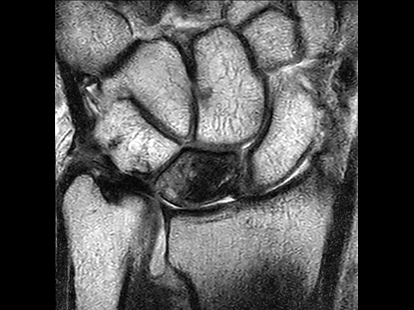 Coronal T2w TSE<b>Compressed SENSE</b>