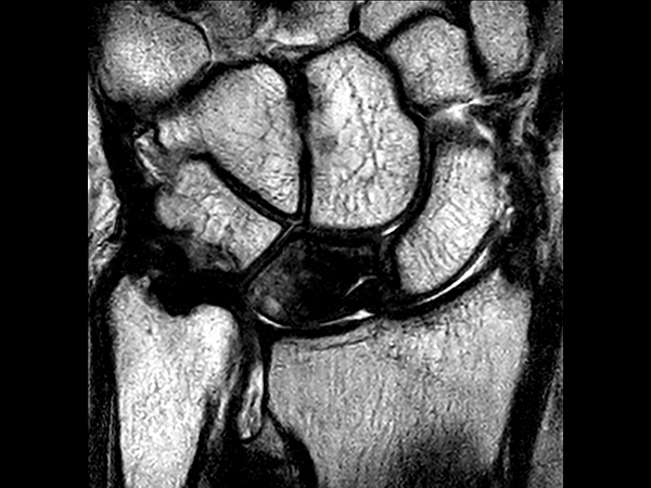 Coronal 3D T2w TSE<b>Compressed SENSE</b>