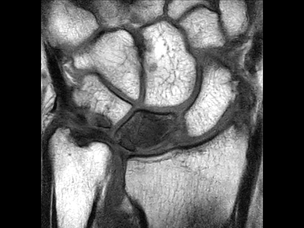 Coronal 3D T1w TSE<b>Compressed SENSE</b>