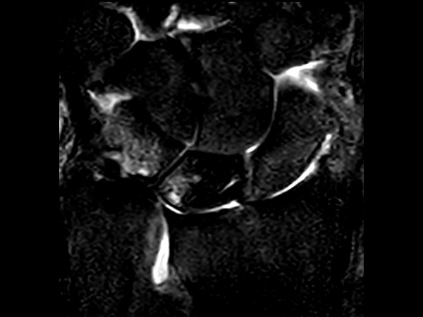 Coronal STIR TSE<b>Compressed SENSE</b>