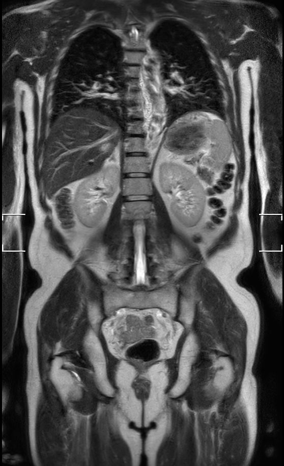 Coronal T2w TSE (2 stations)<b>Dual coil</b>