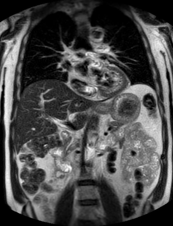 Coronal T2w TSE (1 station)<b>Chest Abdomen - Single coil</b>