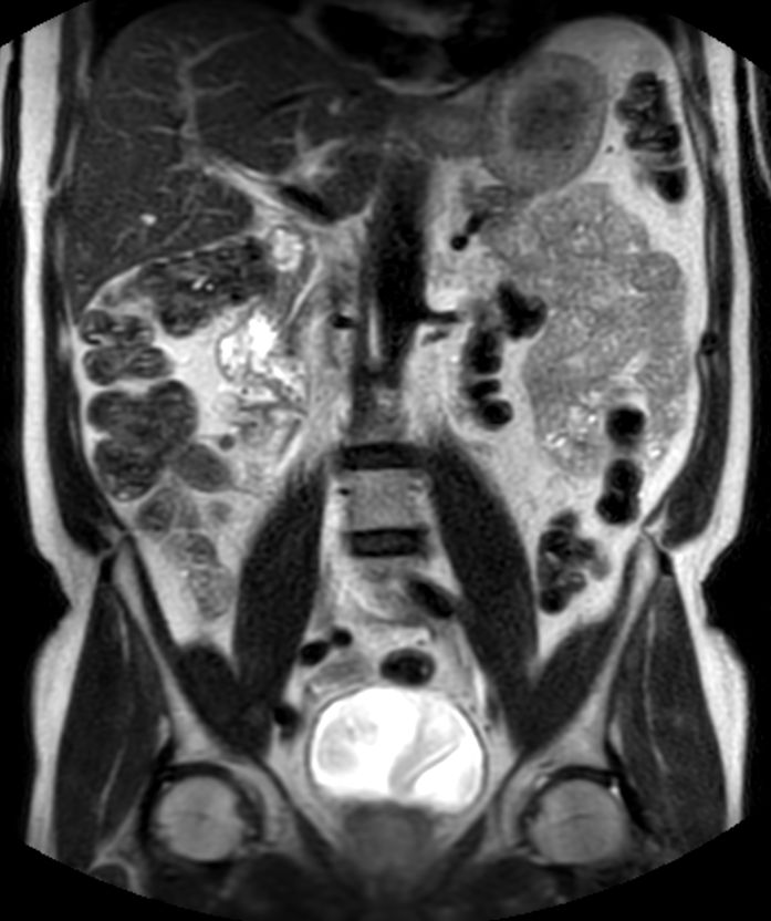 Coronal T2w TSE (1 station)<b>Abdomen Pelvis - Single coil</b>