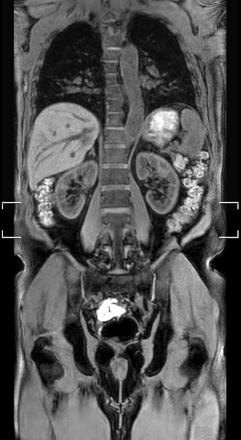 Coronal T1w FFE mDIXON (2 stations)<b>Dual coil - Compressed SENSE</b>
