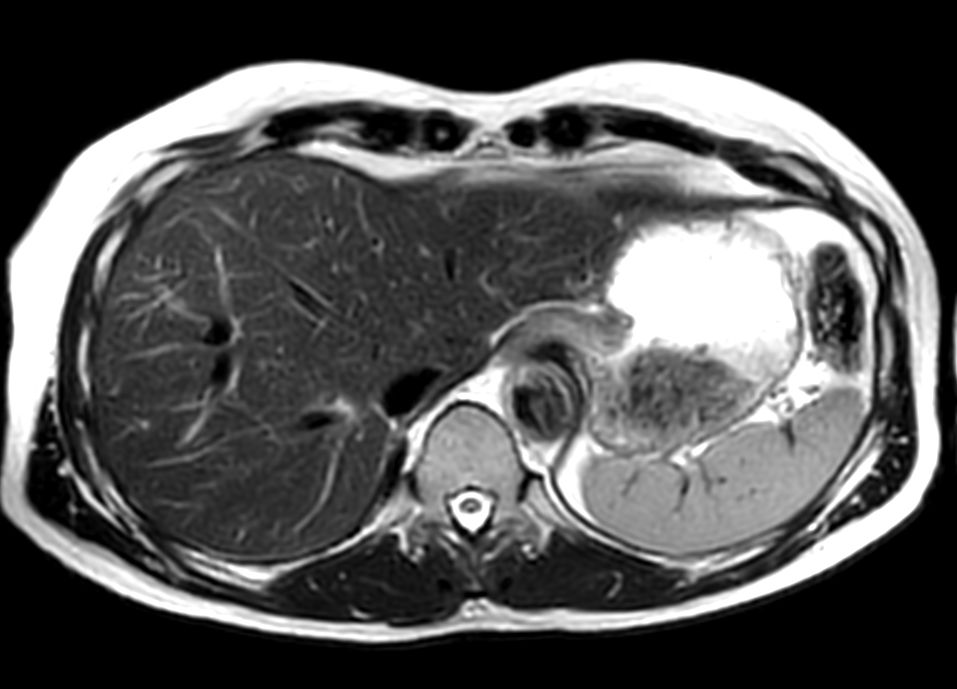 Axial T2w TSE MultiVane XD