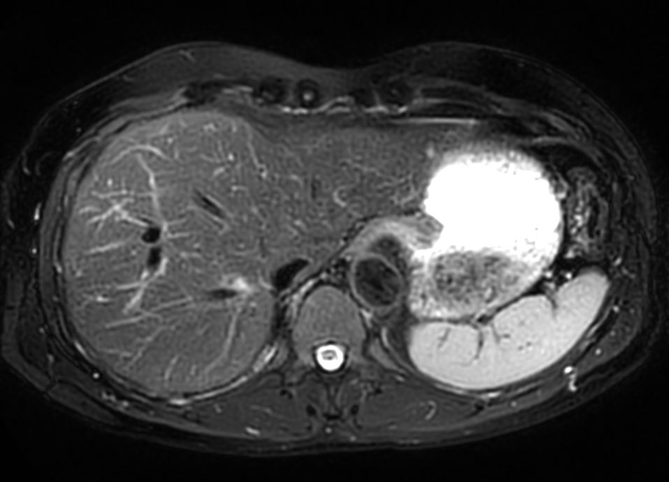 Axial T2w SPIR MultiVane XD