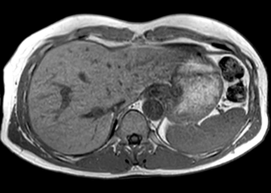 Axial Dual FFE (In Phase)